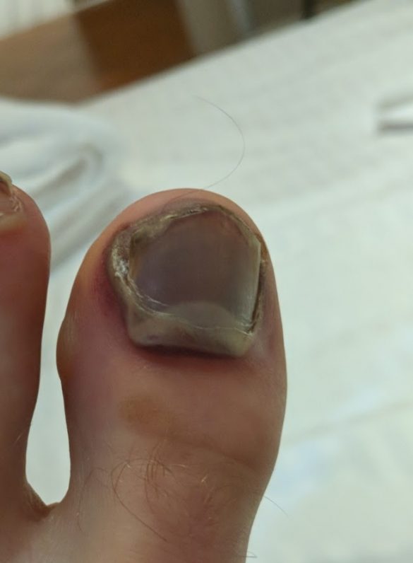 Runner’s Toe: Preventing And Treating Black Toenails